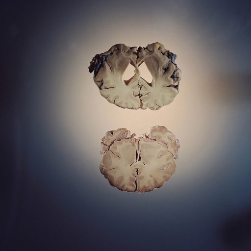 Two slices of human brains illustrate what happens to the brain when it is attacked by Alzheimer's Disease.  The bottom slice is a brain that was healthy and in tact at the death.  The top slice shows the ravages of Alzheimer's and the reason that people lose their memories and die from this dreaded thief of self.